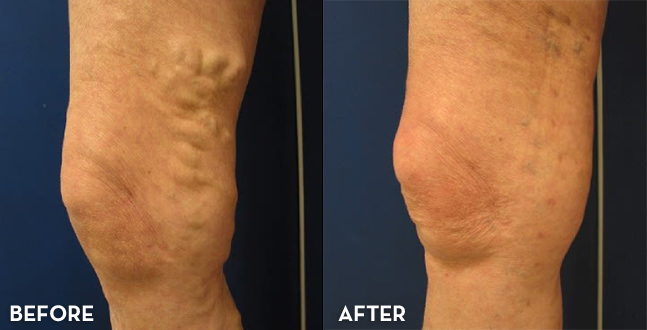 Vein Treatment Results Legs Before and After | La Fontaine Aesthetics
