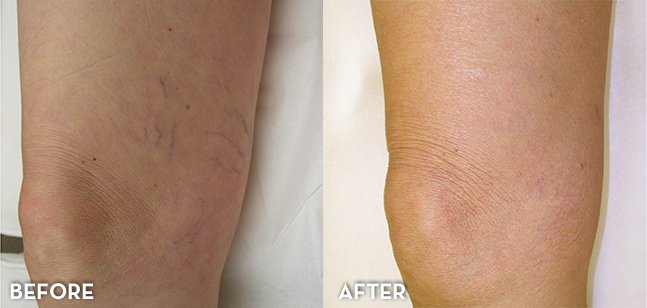 Vein Treatment Results Legs Before and After | La Fontaine Aesthetics