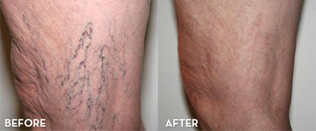 Before and after varicose vein treatment in Denver at La Fontaine Aesthetics
