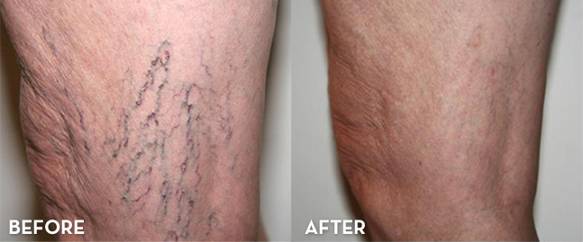 Spider Vein Treatment Denver