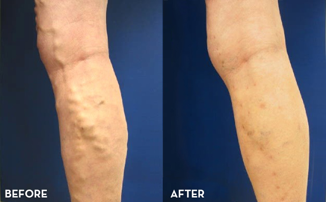 Vein Treatment Results Before and After | La Fontaine Aesthetics